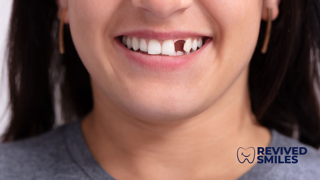 From Implants to Dentures: Detailed Guide on Replacing Missing Teeth