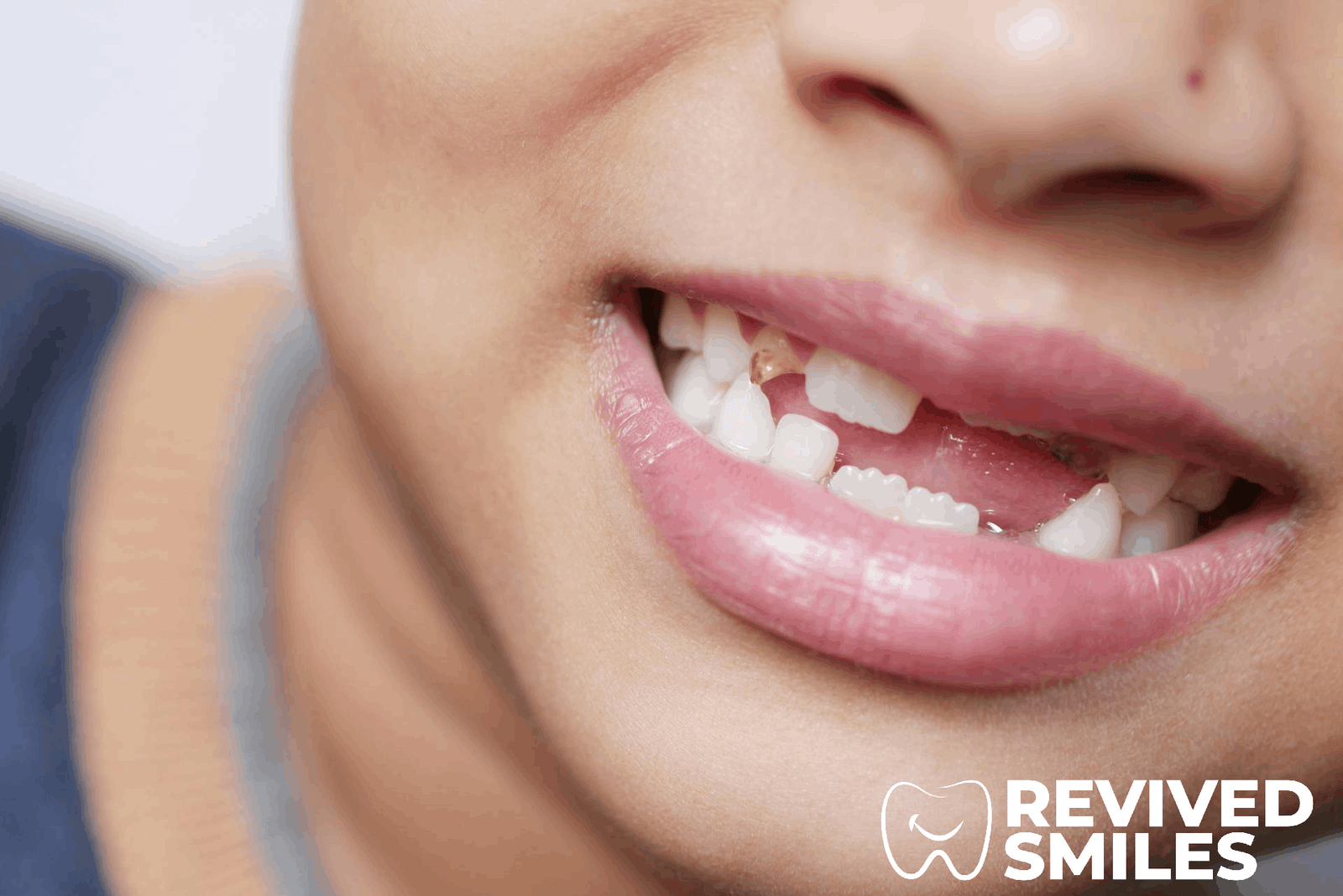 What to Eat with No Teeth While Waiting for Dentures
