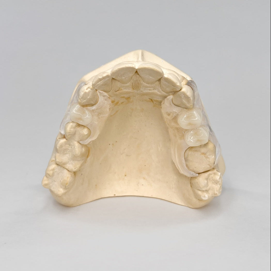 2 Tooth Clear Unilateral Partial Denture on Stone Model