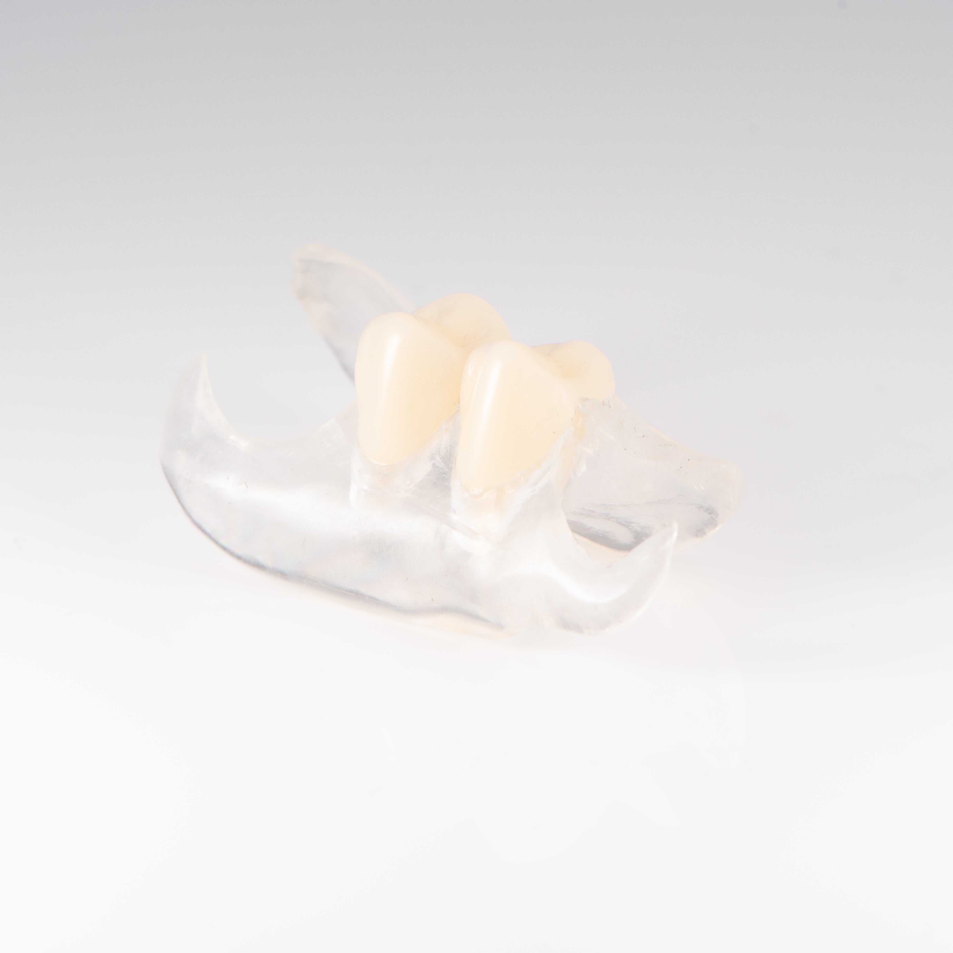 Clear Unilateral Partial Denture