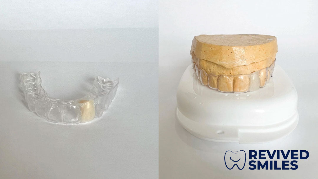 Essix Partial Denture Retainer - Revived Smiles