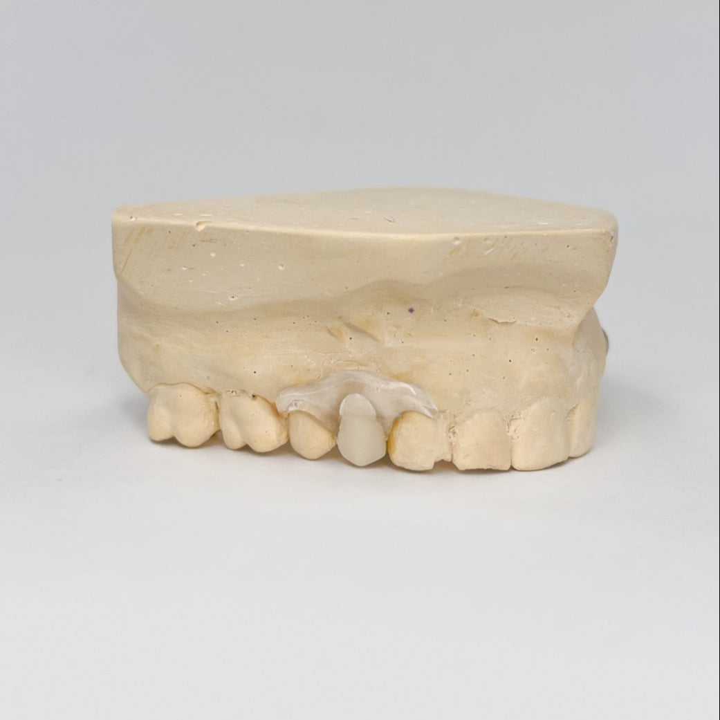 Clear Unilateral Partial Denture