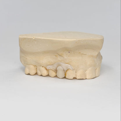1 Tooth Clear Unilateral Partial Denture