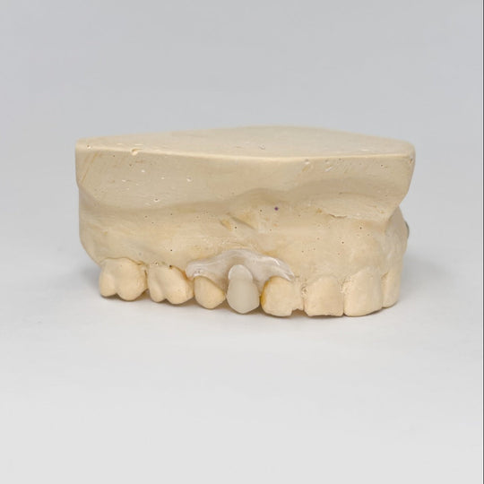 Clear Unilateral Partial Denture