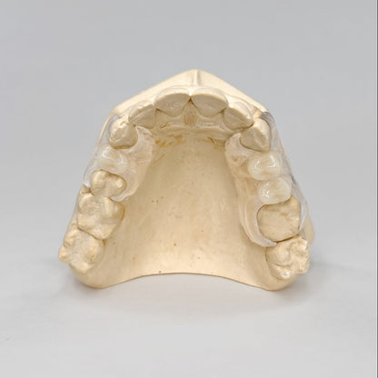 2 Tooth Clear Unilateral Partial Denture on Stone Model