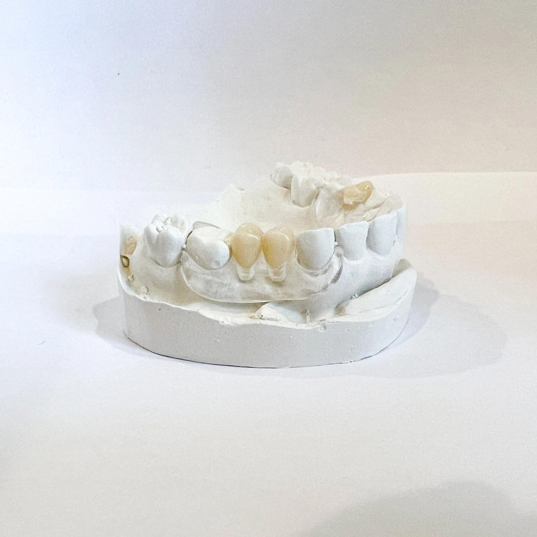 Clear Unilateral Partial Denture