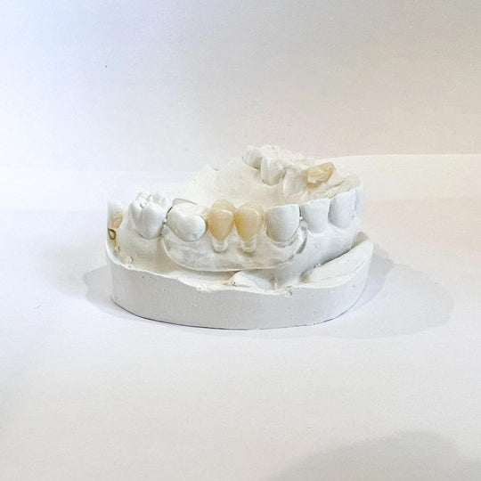 Clear Unilateral Partial Denture