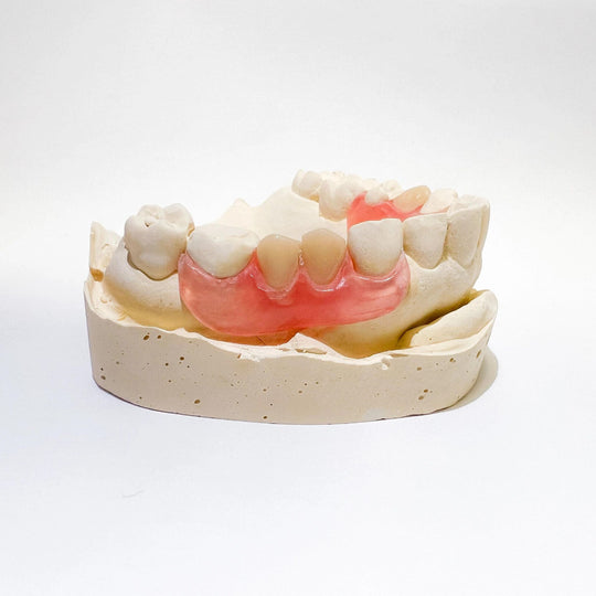 Unilateral Partial Denture