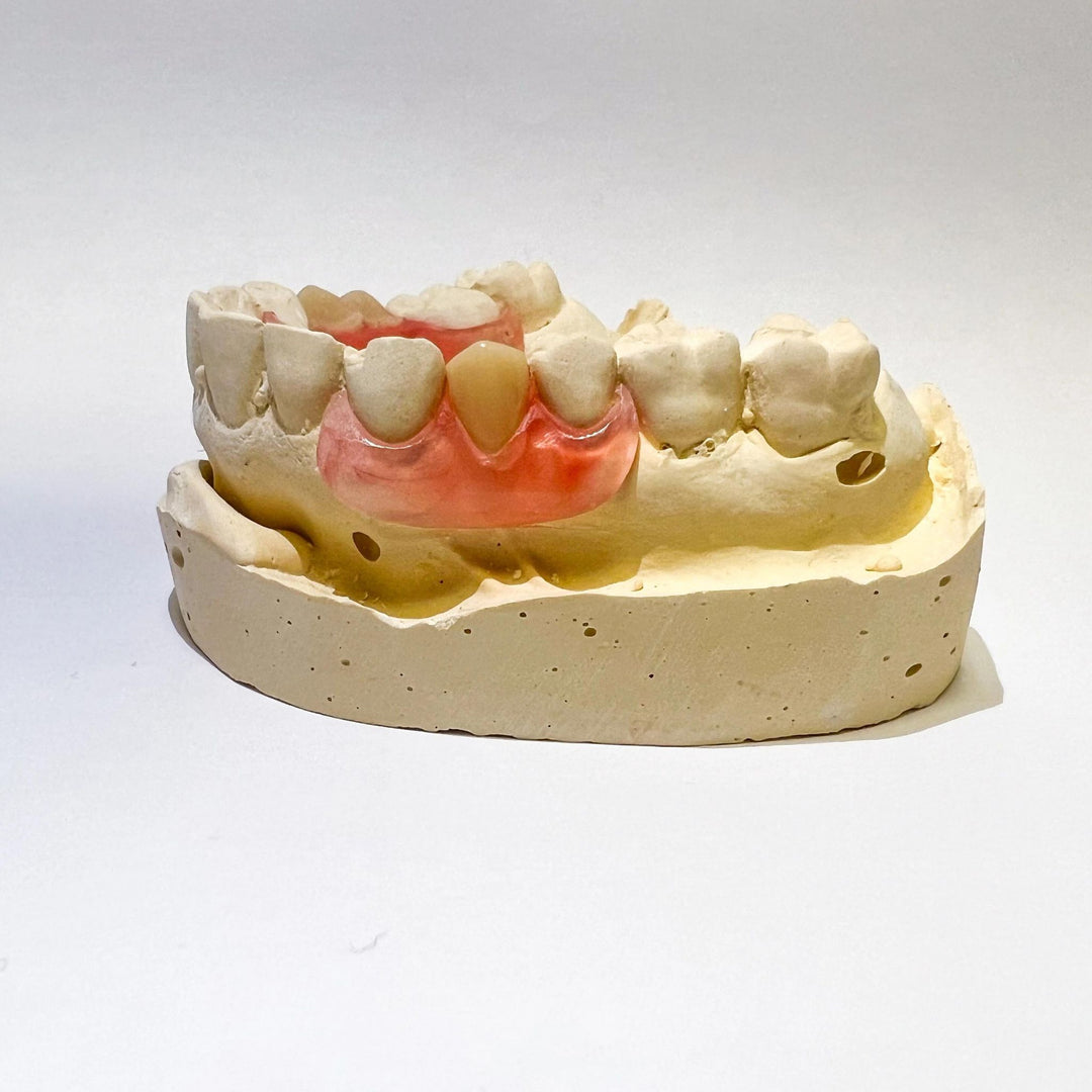 Unilateral Partial Denture