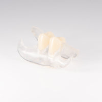 Clear Unilateral Partial Denture
