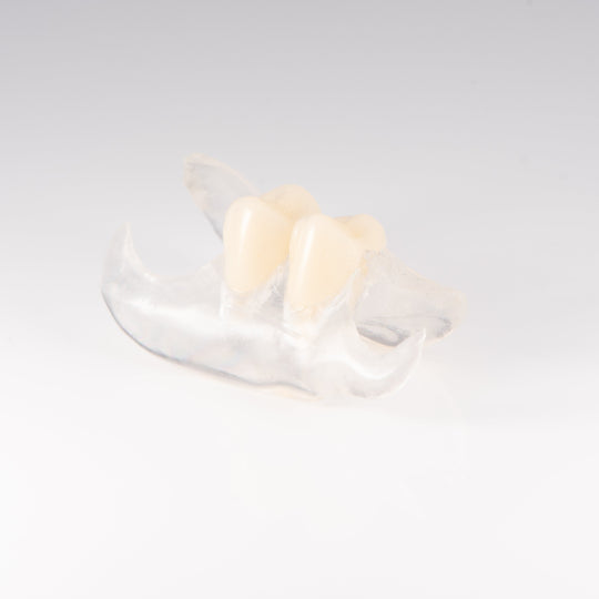 Clear Unilateral Partial Denture