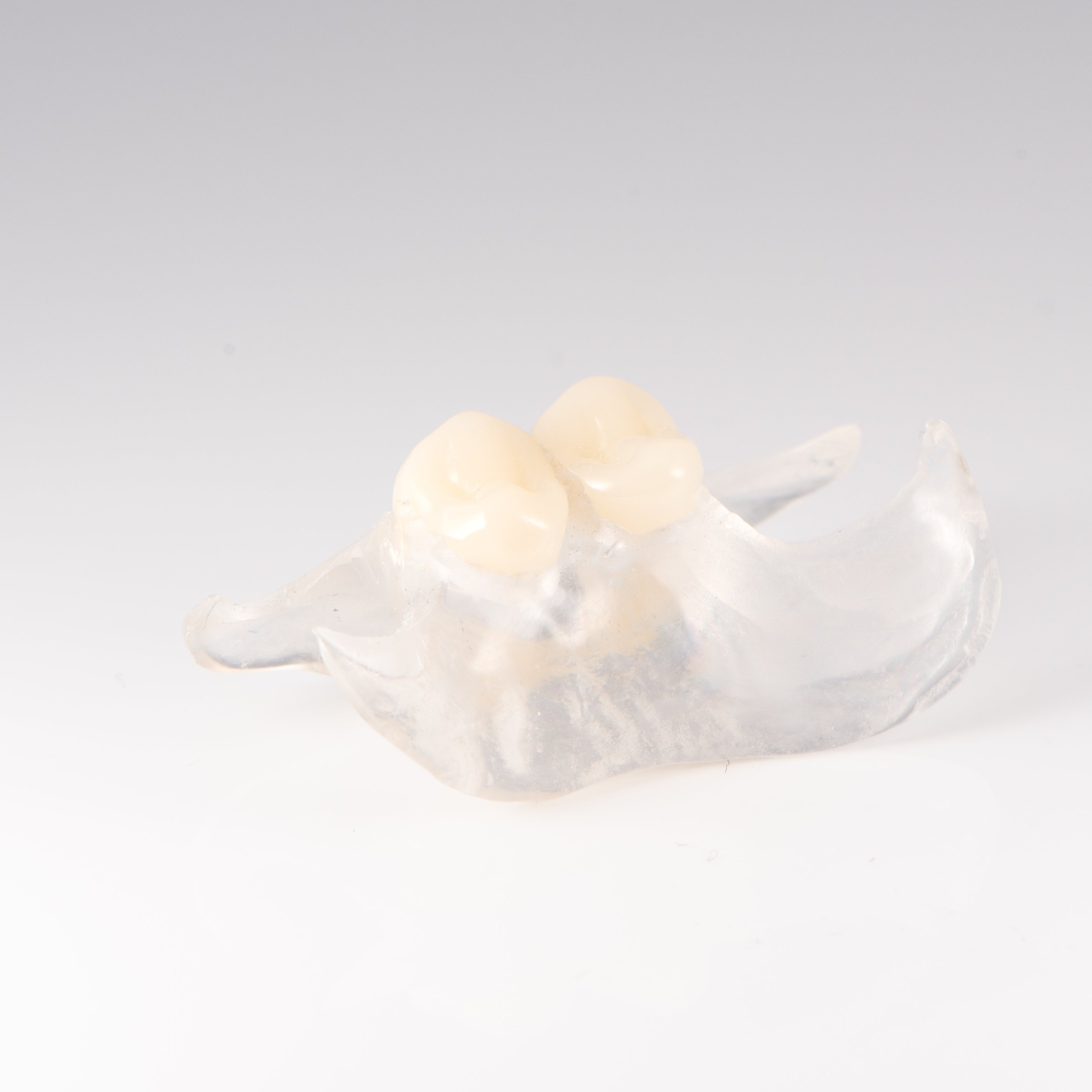 Clear Unilateral Partial Denture