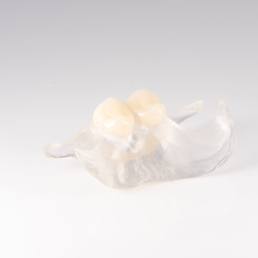 Clear Unilateral Partial Denture
