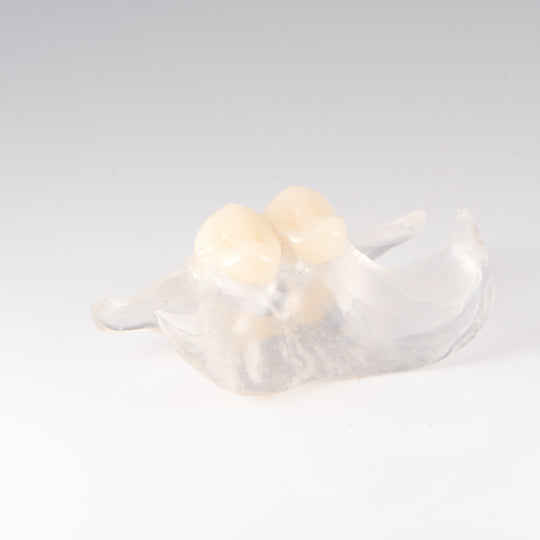 Clear Unilateral Partial Denture