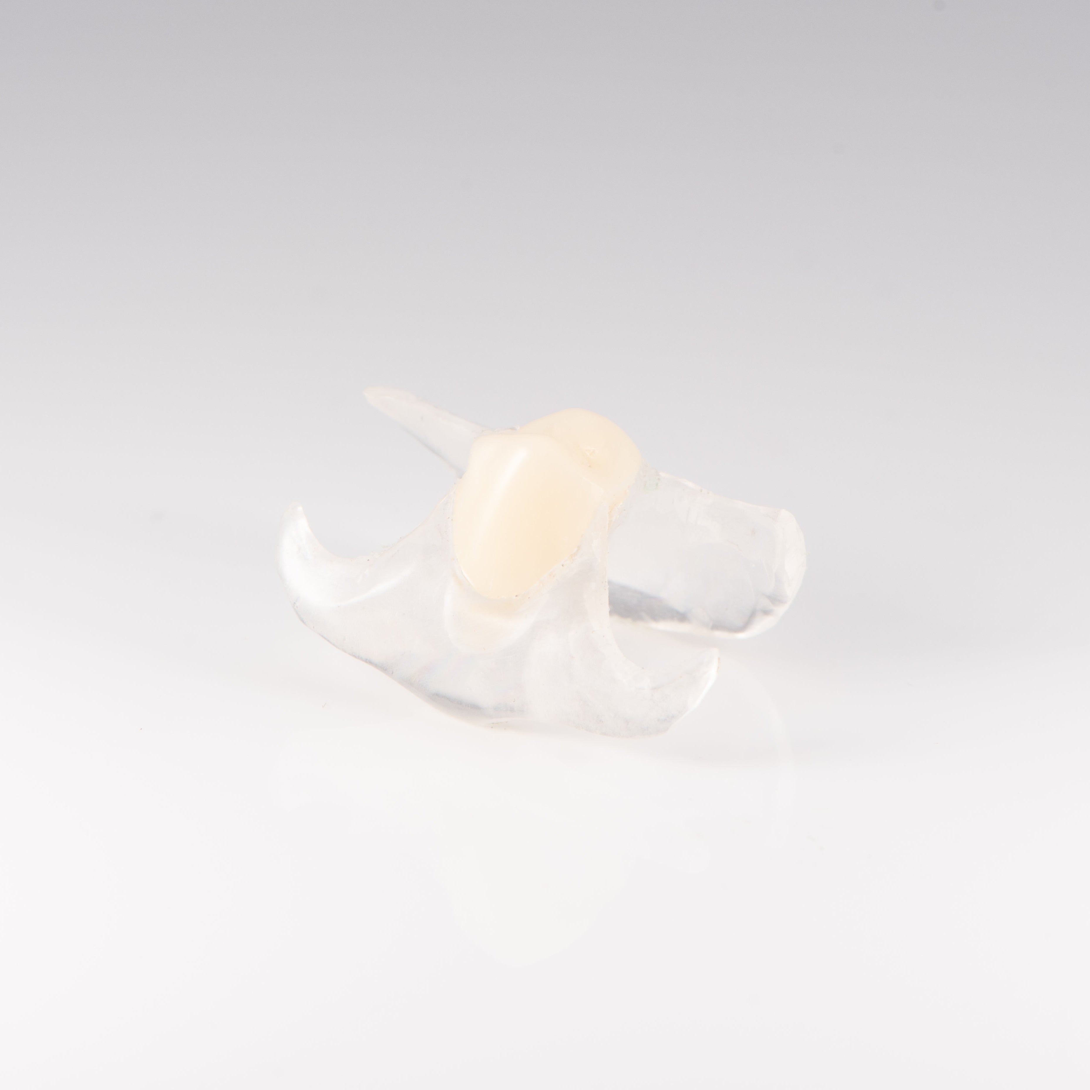 Clear Unilateral Partial Denture
