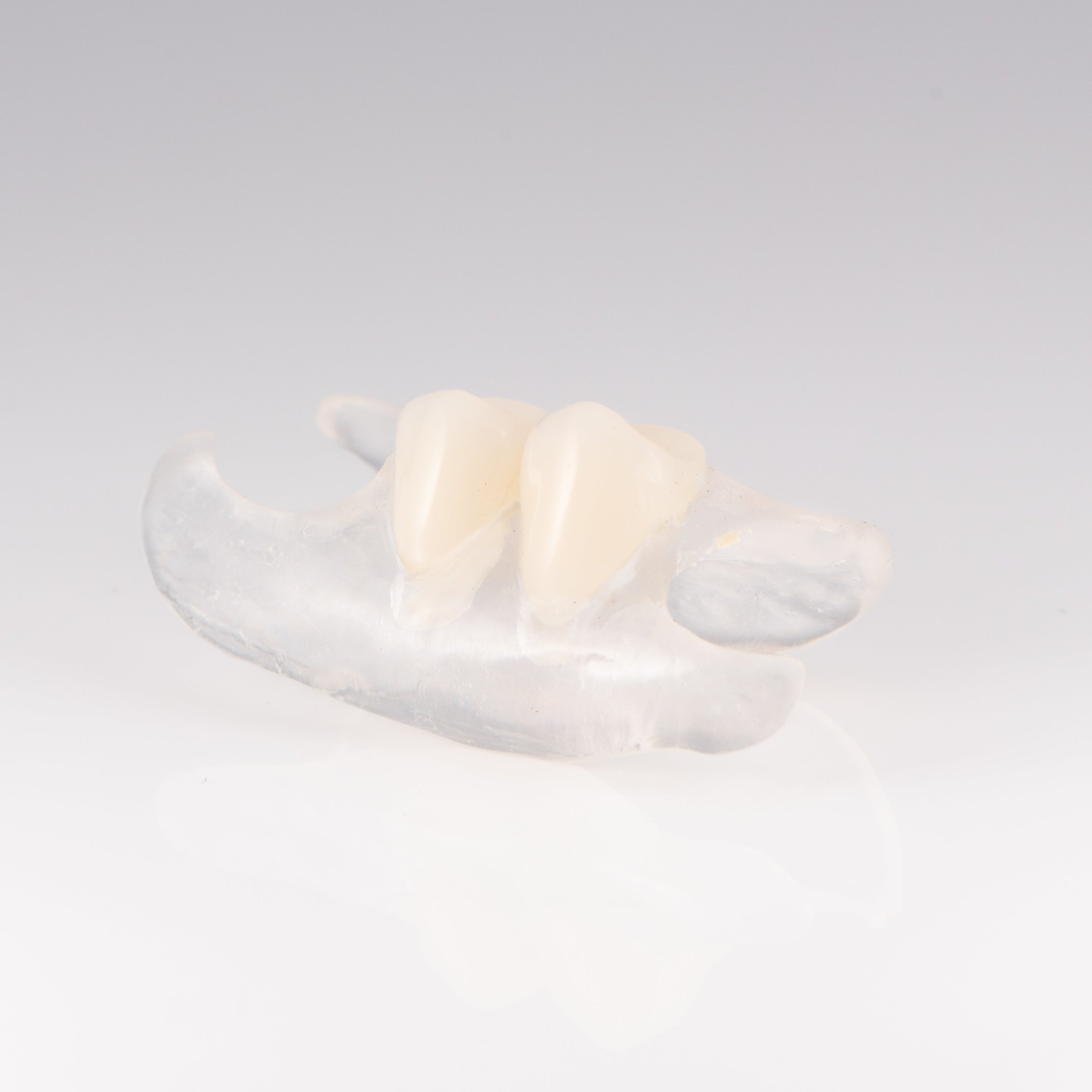 Clear Unilateral Partial Denture