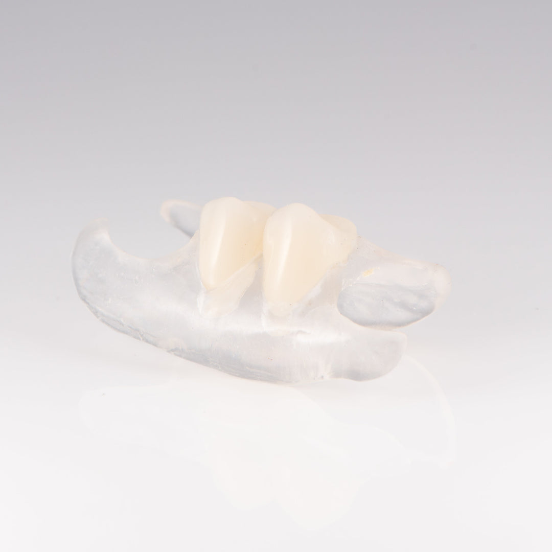 Clear Unilateral Partial Denture