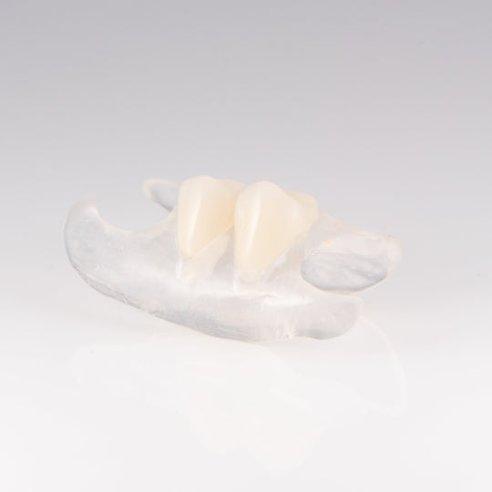 Clear Unilateral Partial Denture