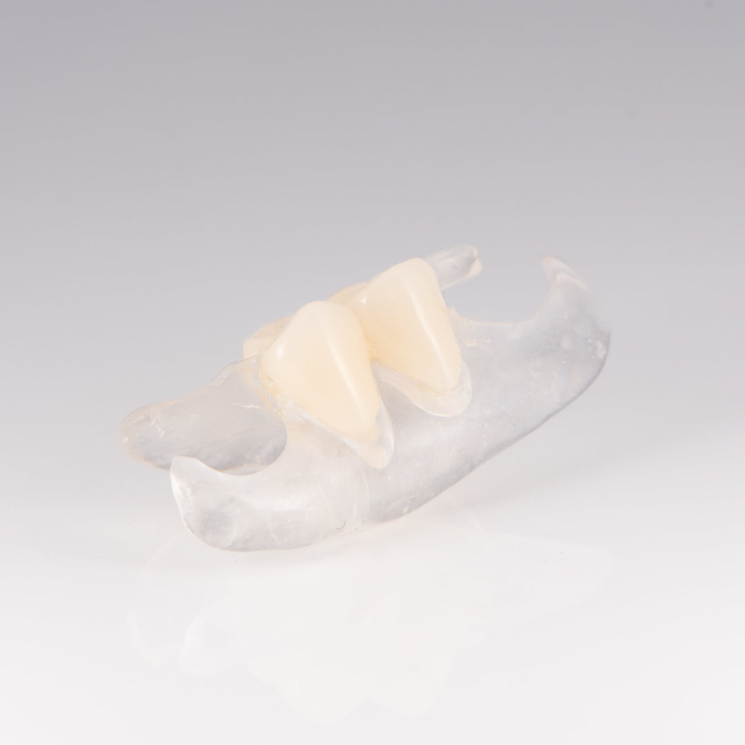 Clear Unilateral Partial Denture