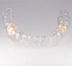 Essix Partial Denture Retainer - Buy Online – Revived Smiles