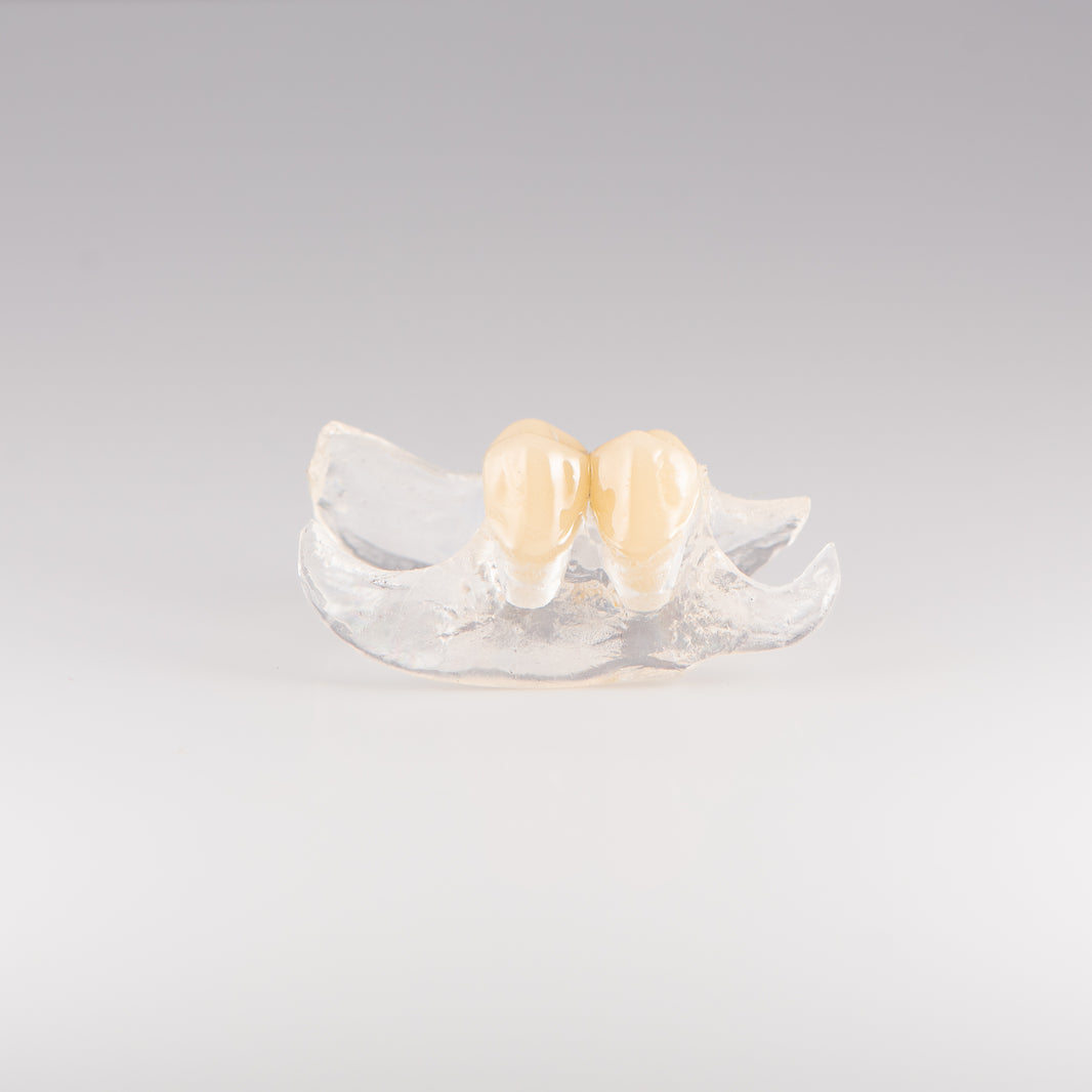 Essix Partial Denture Retainer - Buy Online – Revived Smiles