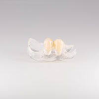 Clear Unilateral Partial Denture