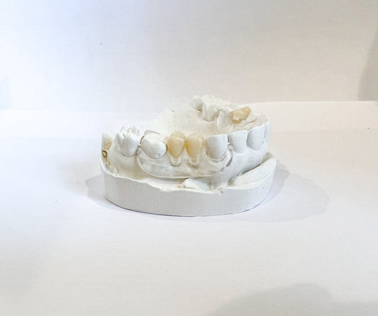 Clear Unilateral Partial Denture