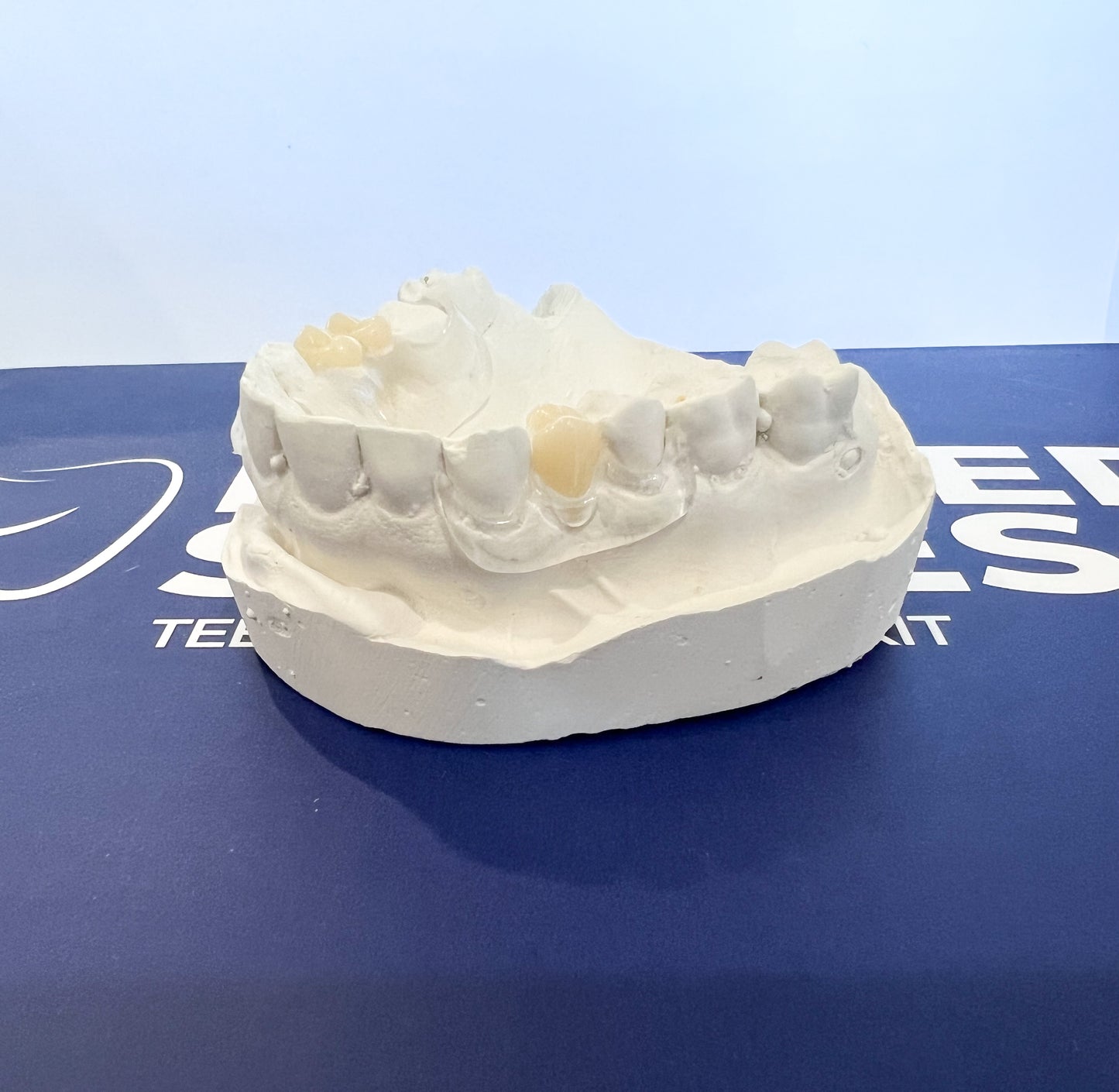 Clear Unilateral Partial Denture