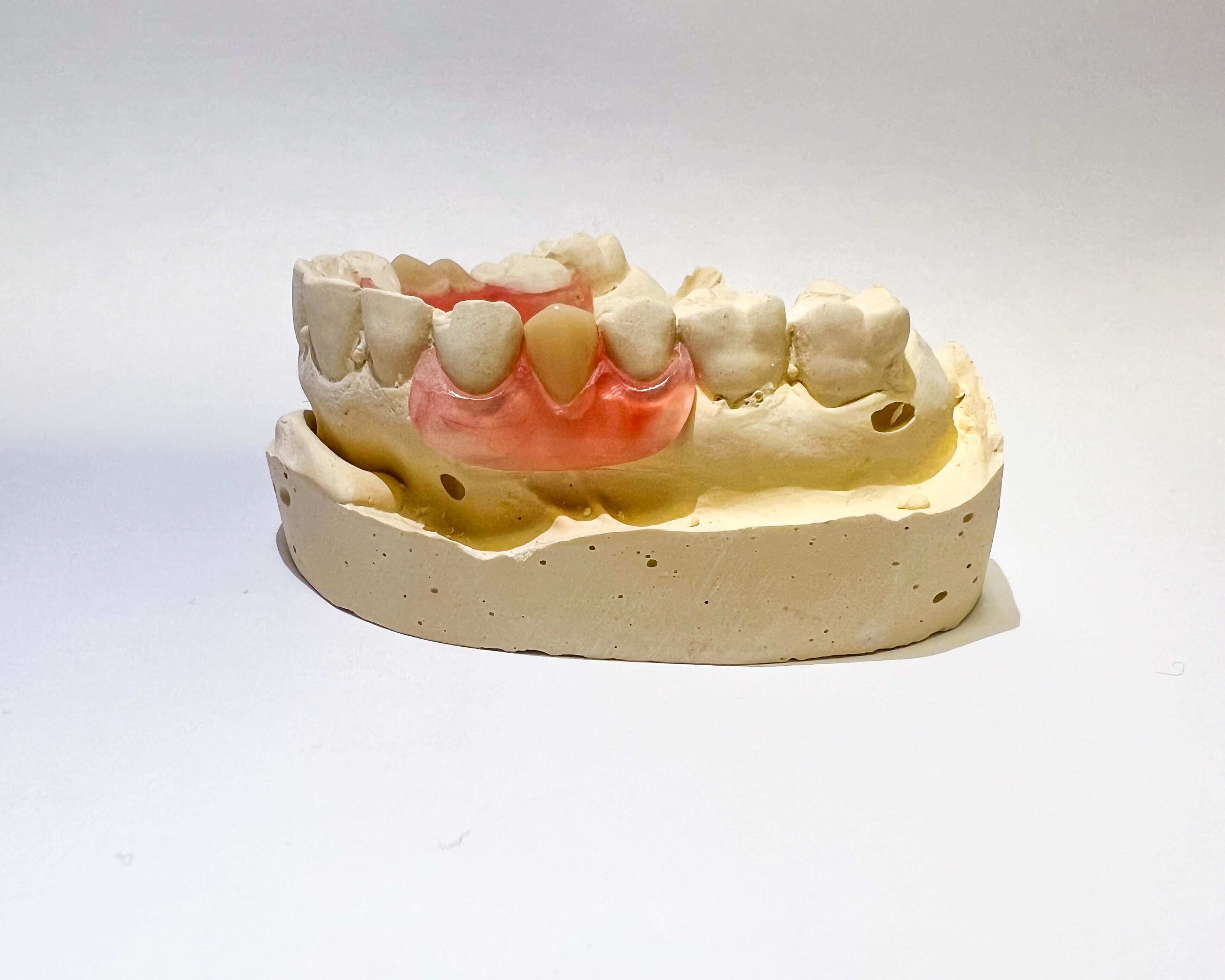 Unilateral Partial Denture Revived Smiles