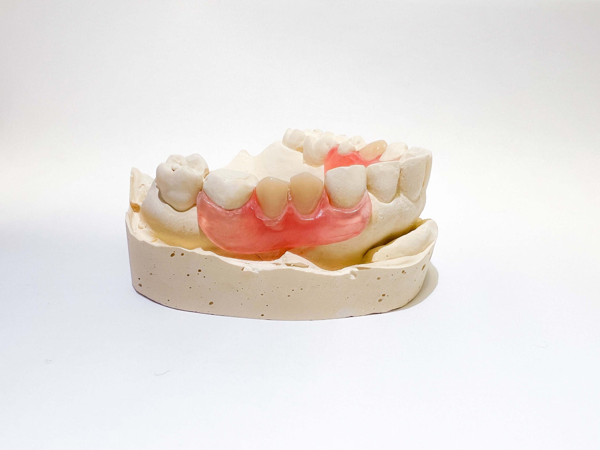 Unilateral Partial Denture Revived Smiles Unilateral Partial Denture Revived Smiles